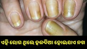 ଏହି ସବୁ ରୋଗ ହେଲେ ହଳଦିଆ ପଡ଼ିଯାଏ ନଖ... ଏହି ସବୁ ରୋଗ ହେଲେ ହଳଦିଆ ପଡ଼ିଯାଏ ନଖ...